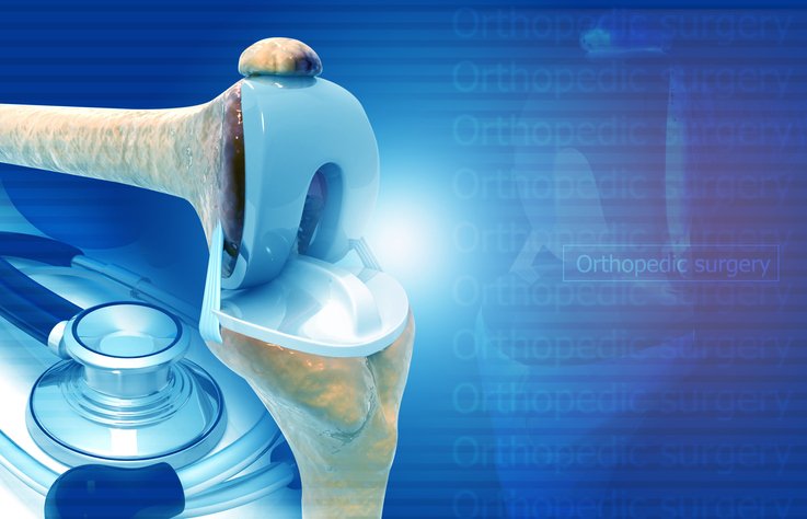 Knee joint replacement. medical background concept
